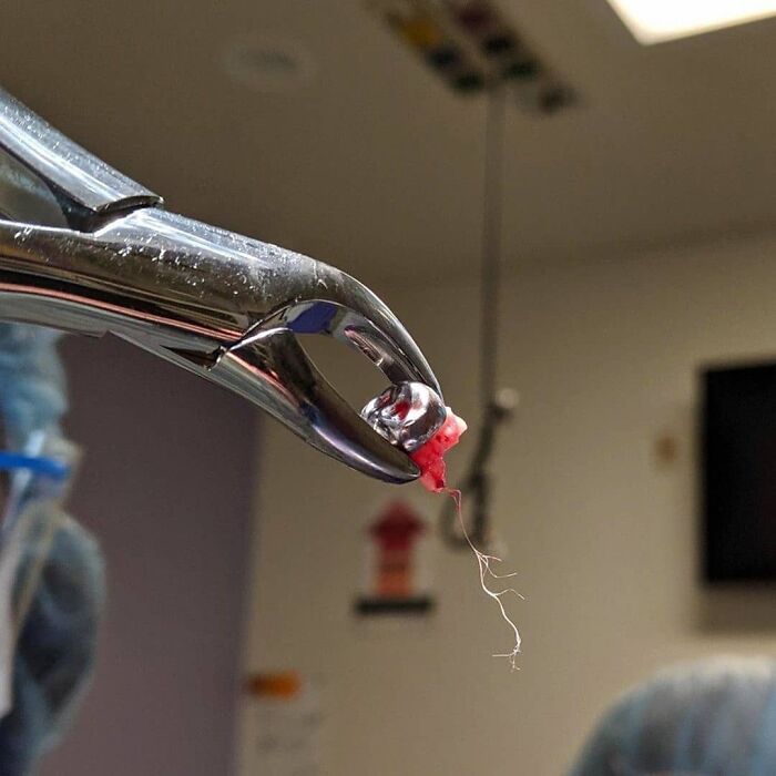 Pinza quirúrgica sosteniendo una pieza dentaria con tejido y raíces extraída en un entorno médico.