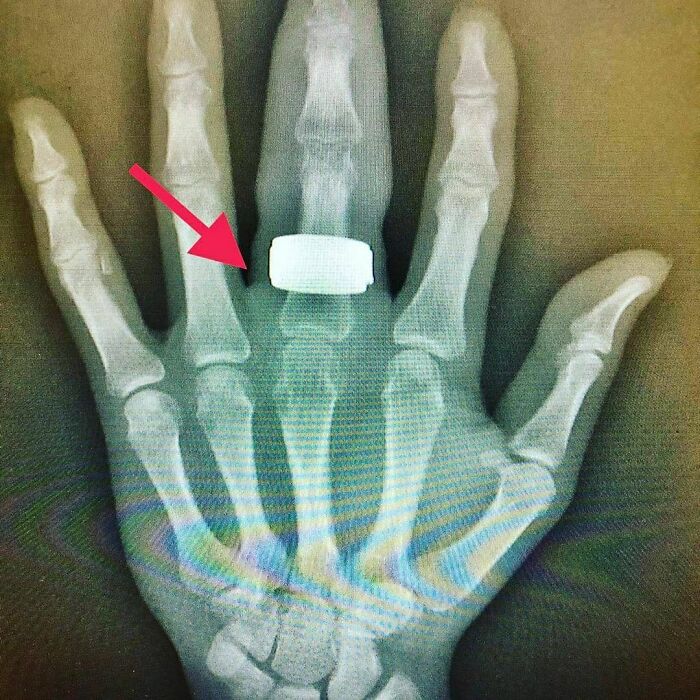 X-ray of a hand showing an uncanny medical implant or foreign object on the middle finger bone highlighted by a red arrow.
