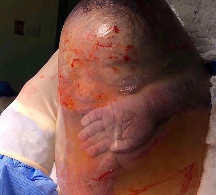 Mano visible dentro de una masa translúcida, imagen médica fascinante y inquietante mostrando un caso raro.
