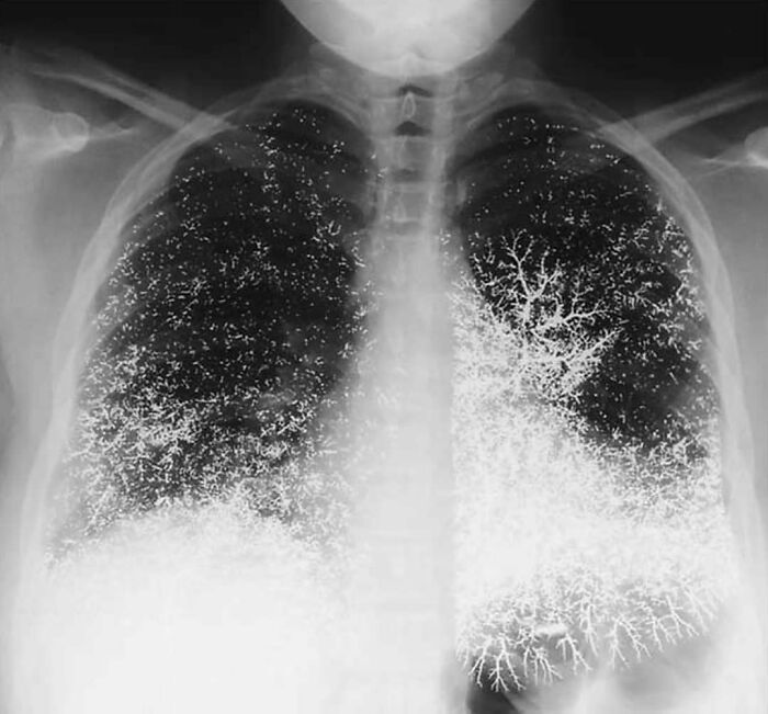 X-ray image showing uncanny branching patterns in the lungs, highlighting moments when medicine crossed into the uncanny.