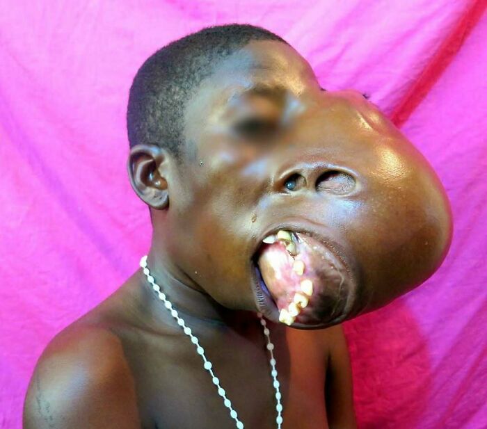 Child with a large facial tumor and dental abnormalities, illustrating uncanny medical conditions and rare disease moments.