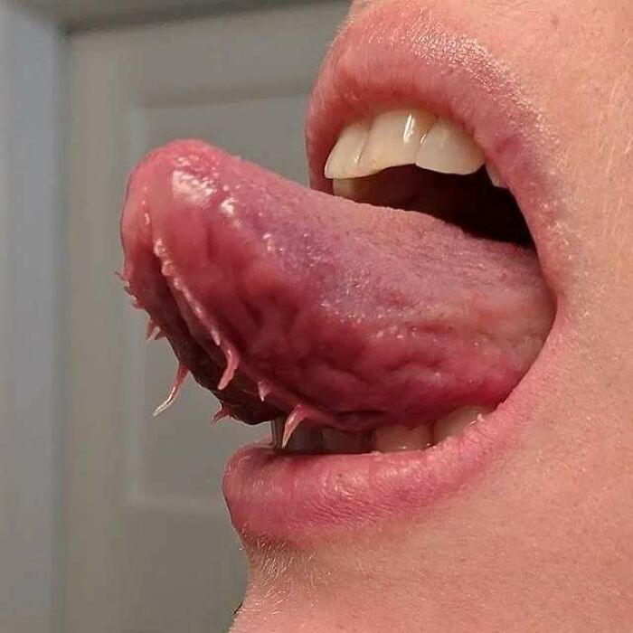 Close-up of a person’s tongue with unusual spiky growths, showing an uncanny moment in medicine.