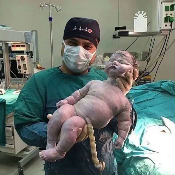 Médico sostiene bebé con aspecto inusual y cordón umbilical en quirófano, foto médica fascinante e inquietante.