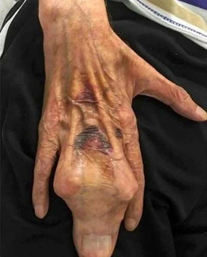 A close-up of an aged hand with unusual swelling and bruising, illustrating uncanny moments in medicine.