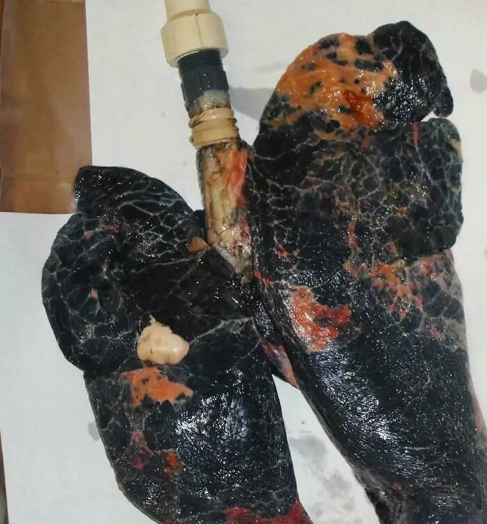 Preserved human lungs with severe black and orange discoloration showing uncanny medical effects of disease.