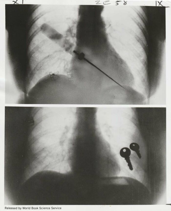 Vintage X-ray images showing a pipe and two keys inside a person's chest, highlighting interesting and mesmerizing history.