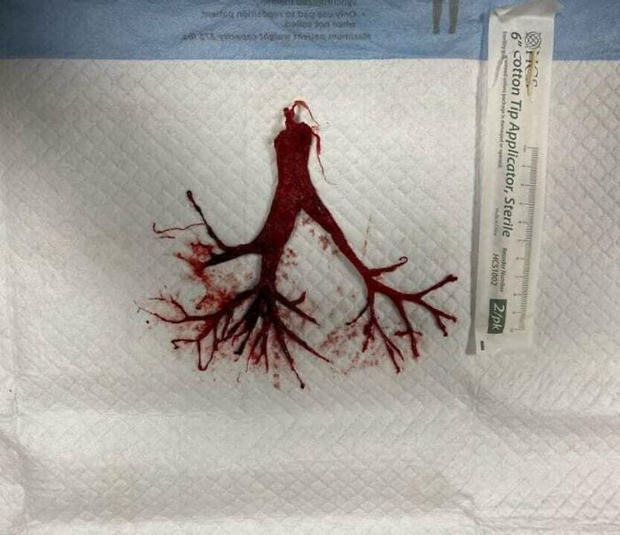 Ramificación pulmonar sanguinolenta extraída, imagen médica fascinante e inquietante que revela estructura anatómica detallada.