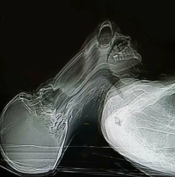 Distorted medical X-ray image showing an uncanny and eerie skeletal structure, highlighting moments when medicine crossed into the uncanny.