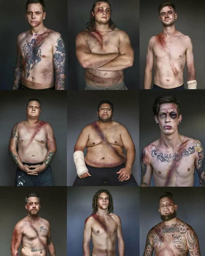 Hombres con heridas y contusiones visibles en el cuerpo, mostrando fotos médicas fascinantes e inquietantes.