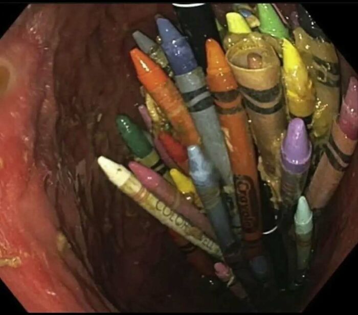 Colorful crayons tightly packed inside a human colon, an uncanny medical case showing foreign object ingestion.