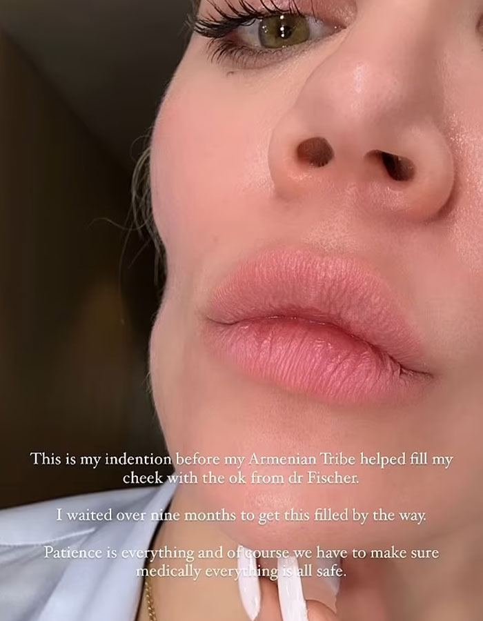 Close-up of a woman’s face showing natural skin and lips before plastic surgery recovery. Close-up of a woman’s face showing natural skin and lips before plastic surgery recovery.