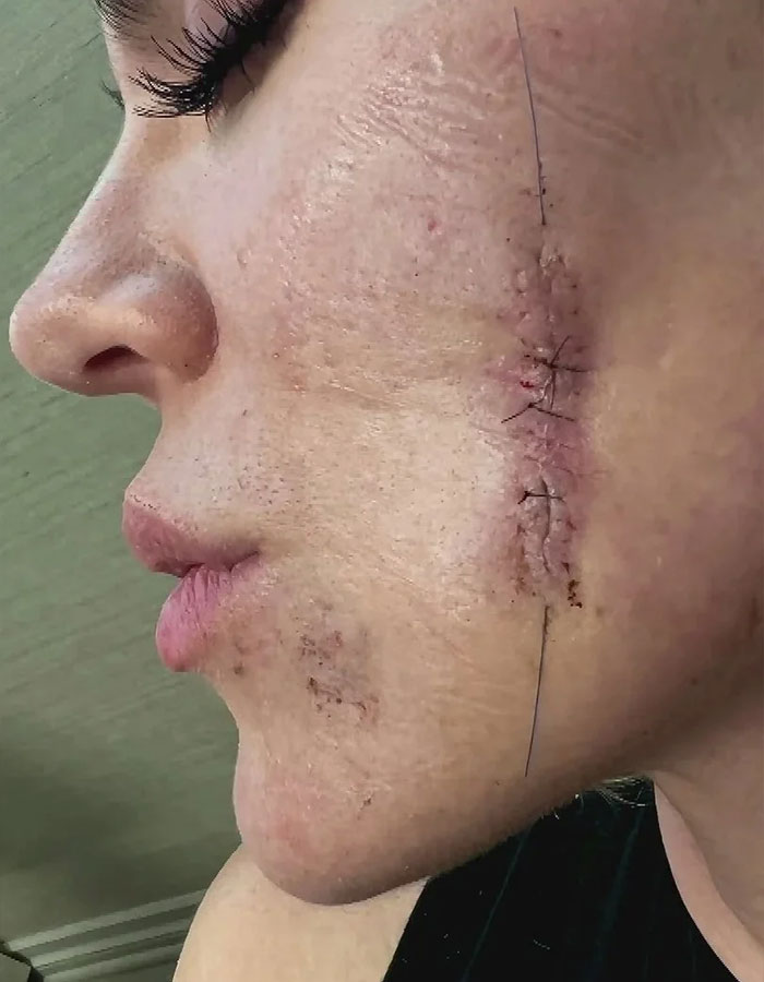 Close-up of a woman's face showing horribly stitched plastic surgery scars along her cheek and jawline. Close-up of a woman's face showing horribly stitched plastic surgery scars along her cheek and jawline.