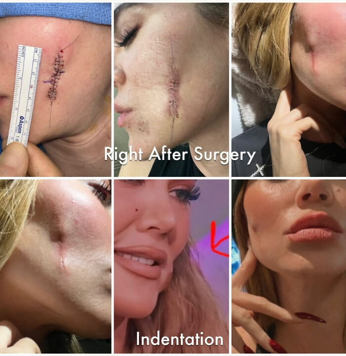 Close-up images showing unnerving plastic surgery stitches and healing on Khloe Kardashian’s face after surgery. Close-up images showing unnerving plastic surgery stitches and healing on Khloe Kardashian’s face after surgery.