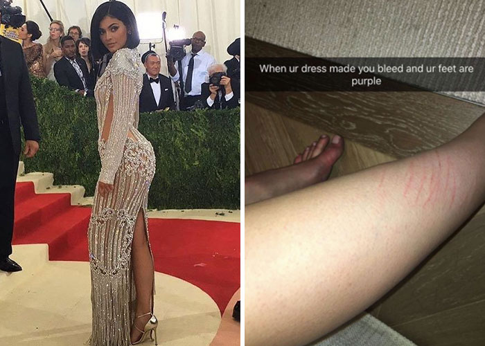 Kylie Jenner on red carpet wearing stiletto heels, next to close-up of leg with scratches and bruises from Met Gala stilletto hack. Kylie Jenner on red carpet wearing stiletto heels, next to close-up of leg with scratches and bruises from Met Gala stilletto hack.