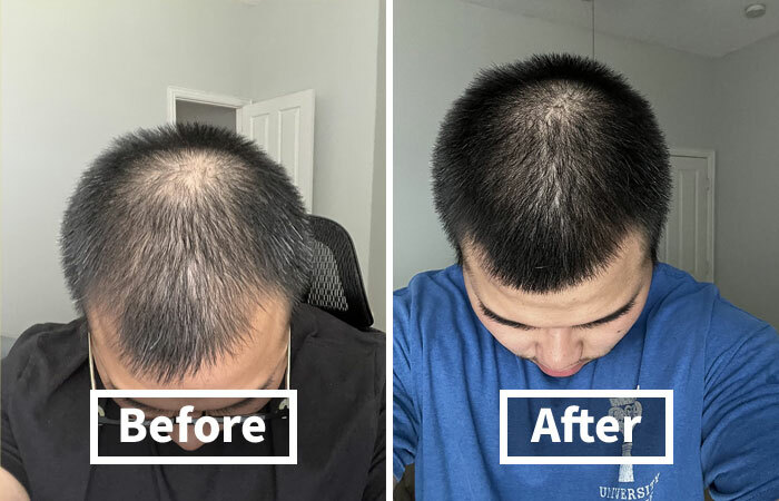 Before and after photos showing a hair restoration solution that fixes everyday annoyances in the coolest way.
