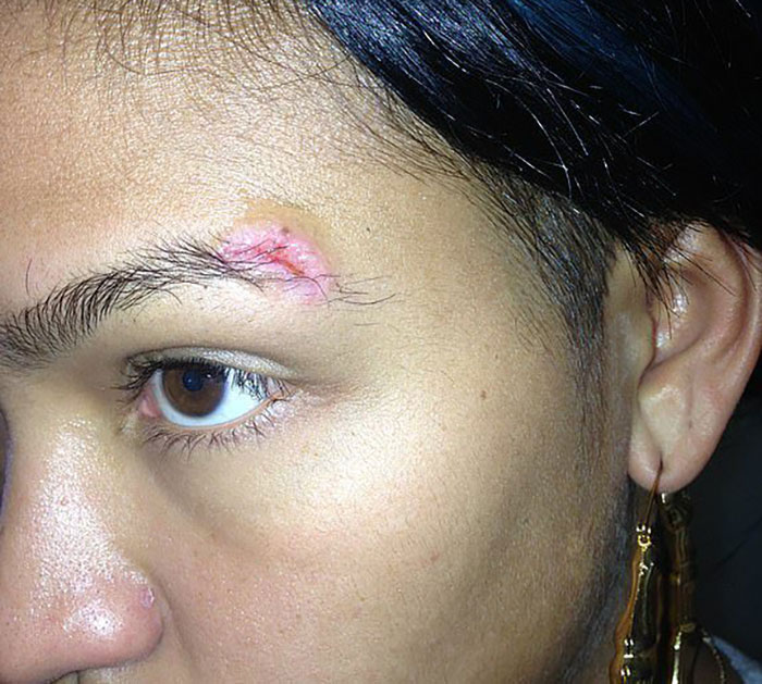 Close-up of a person’s face showing a healed injury near the eyebrow amid dramatic testimonies and Diddy preparation photos. Close-up of a person’s face showing a healed injury near the eyebrow amid dramatic testimonies and Diddy preparation photos.