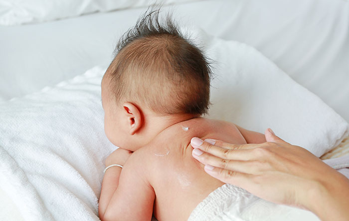 Baby lying on stomach while someone applies cream to their back, illustrating DIY medical treatments gone wrong.