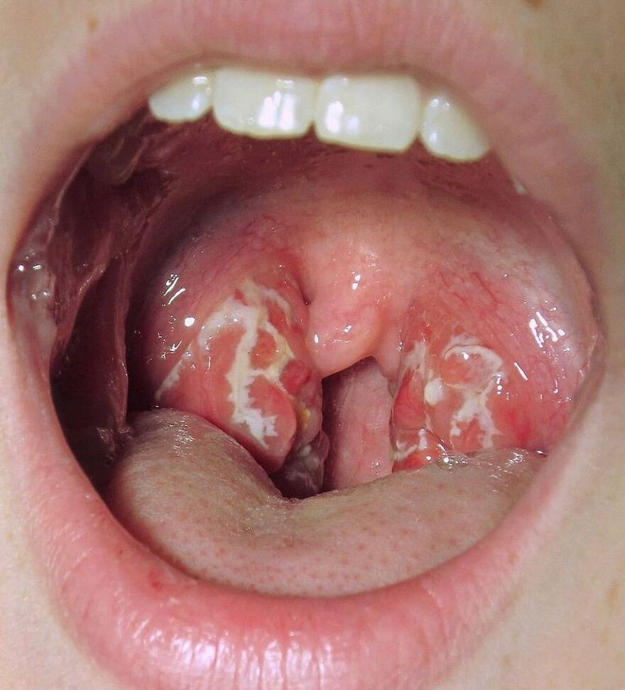Close-up of a mouth showing inflamed tonsils with white patches, part of bizarre medical pics shared on IG account.