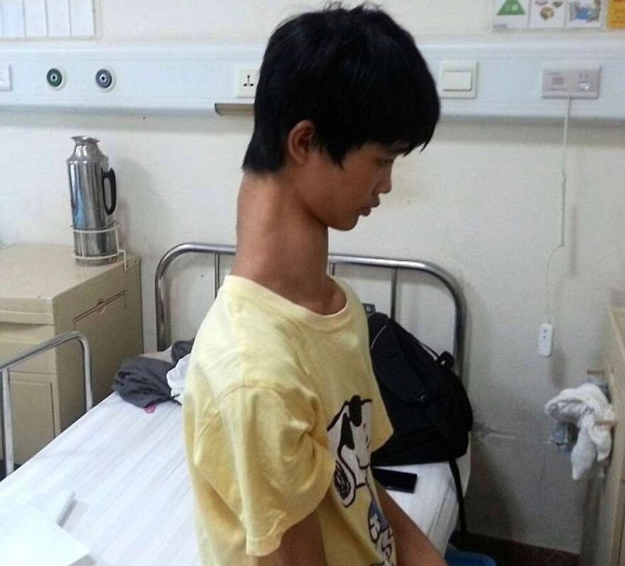 Young man with an unusually large neck sitting on a hospital bed in a room, bizarre medical condition picture.