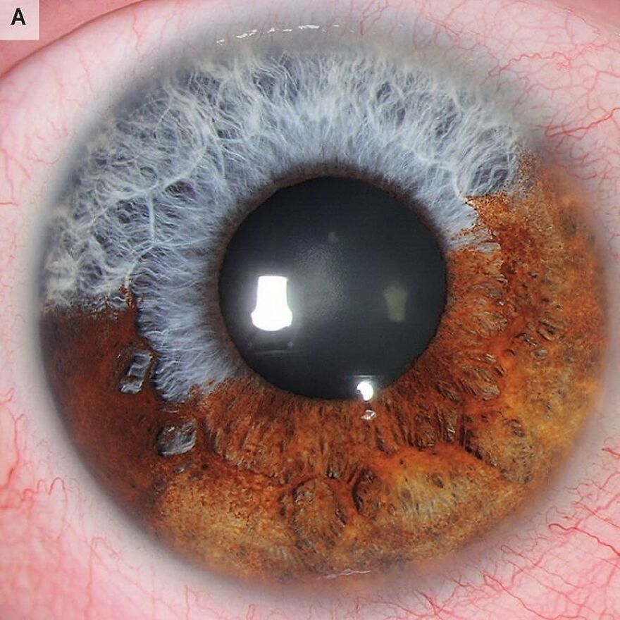 Close-up of a human eye showing unusual brown and blue coloration from a bizarre medical condition shared on an IG account.