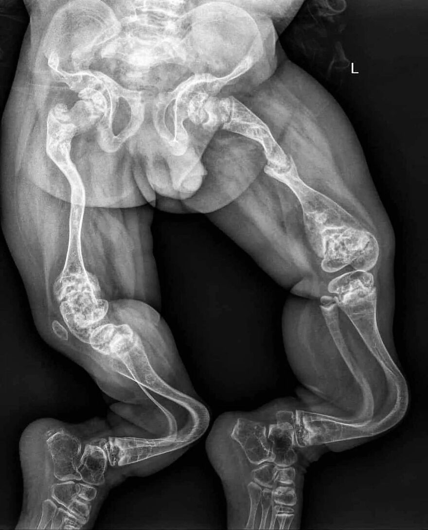 X-ray showing severe leg deformities in a bizarre medical image shared on an IG account featuring eerie medical pics