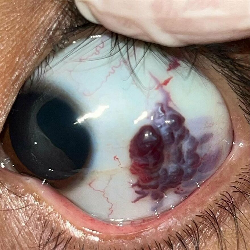 Close-up of an eye showing a bizarre medical condition with abnormal blood vessels and discoloration on the sclera.