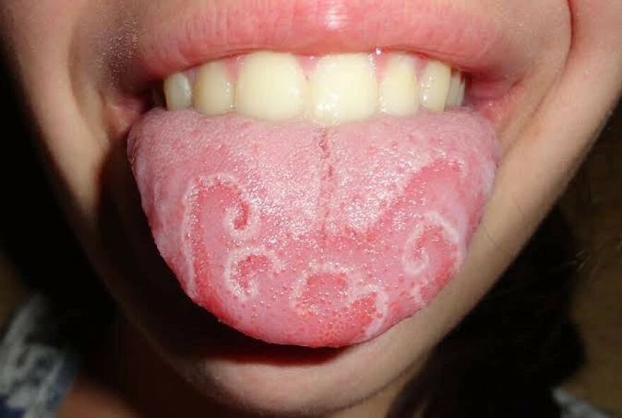 Close-up of a tongue with unusual swirling patterns, shared on an IG account featuring bizarre medical pics.