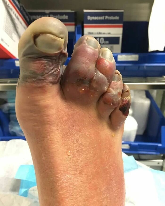 Pie de foto médico de un pie con dedos severamente lesionados e infectados, mostrando lo aterrador que puede ser el cuerpo.