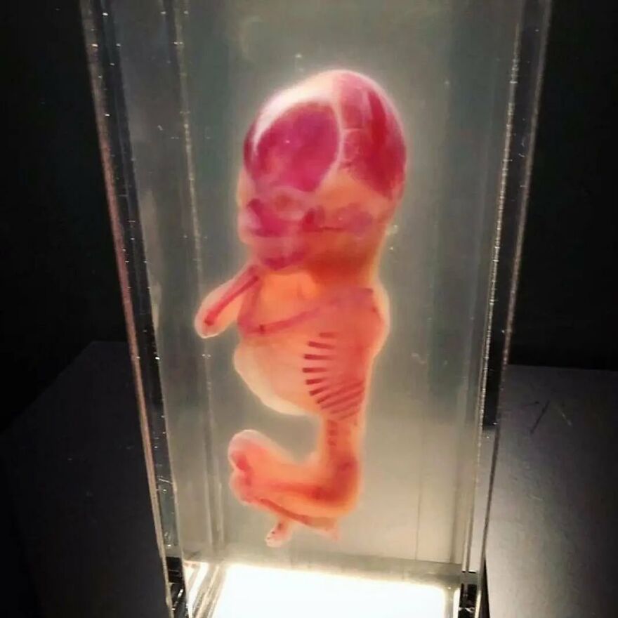 Preserved bizarre medical specimen of a translucent embryo with visible internal structures in a glass display case.