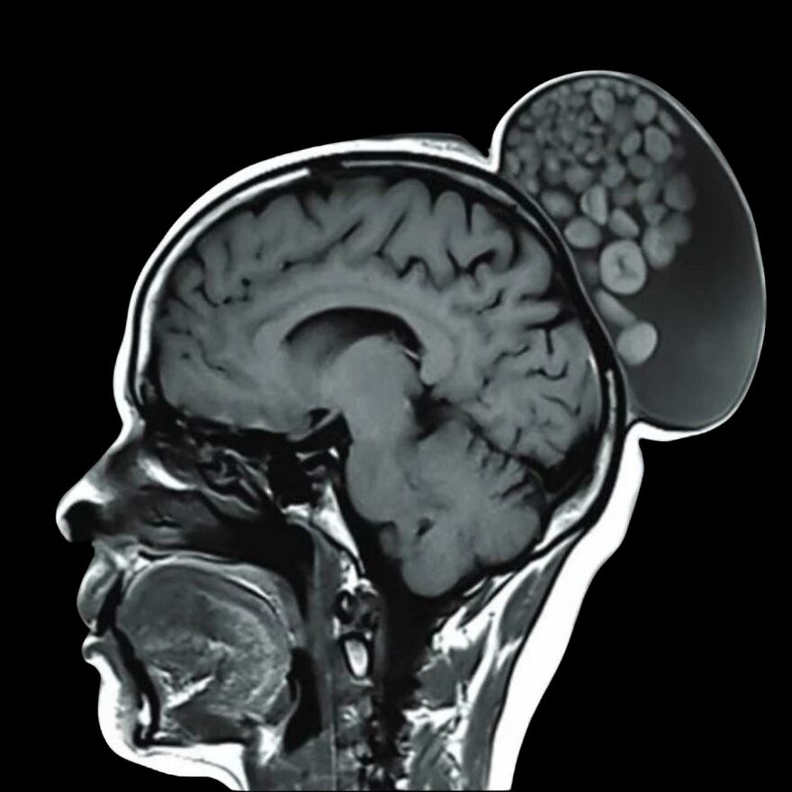 MRI scan of a human head showing brain and an unusual cluster of objects outside the skull in bizarre medical pics.