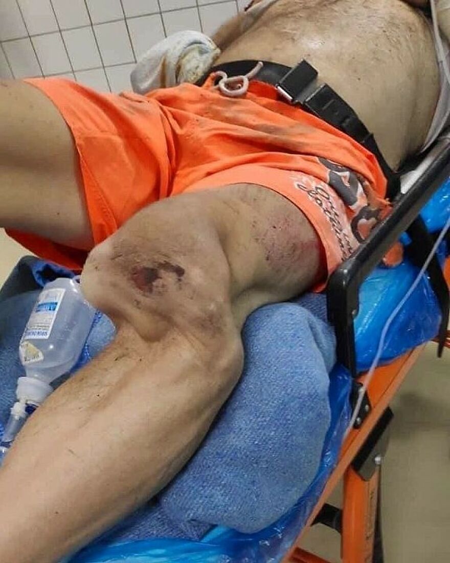 Injured leg with severe bruising and open wound on a patient’s thigh, showcasing bizarre medical condition.