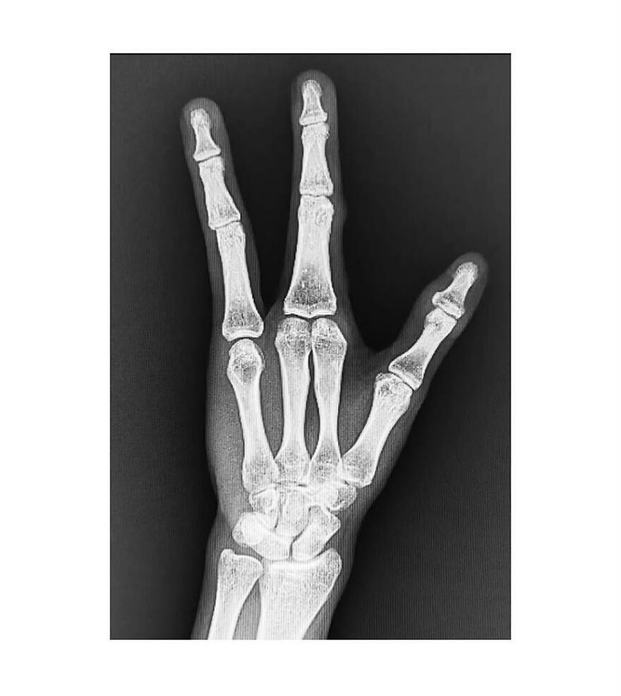 X-ray image of a hand showing overlapping and fused finger bones from bizarre medical pics shared on IG.