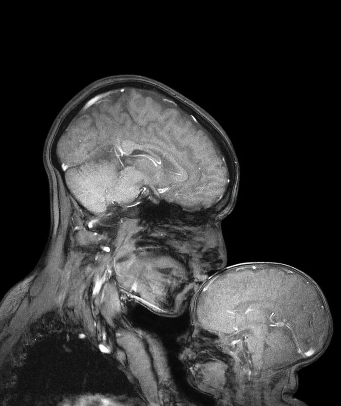 MRI scan showing detailed brain structures of an adult and a child, highlighting medical pics of the body keeping the score.