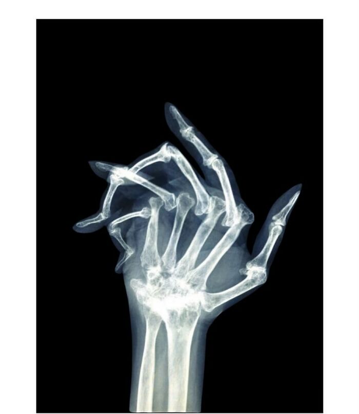 Radiografía médica que muestra deformidad ósea en la mano, una impactante imagen del cuerpo humano aterrador.