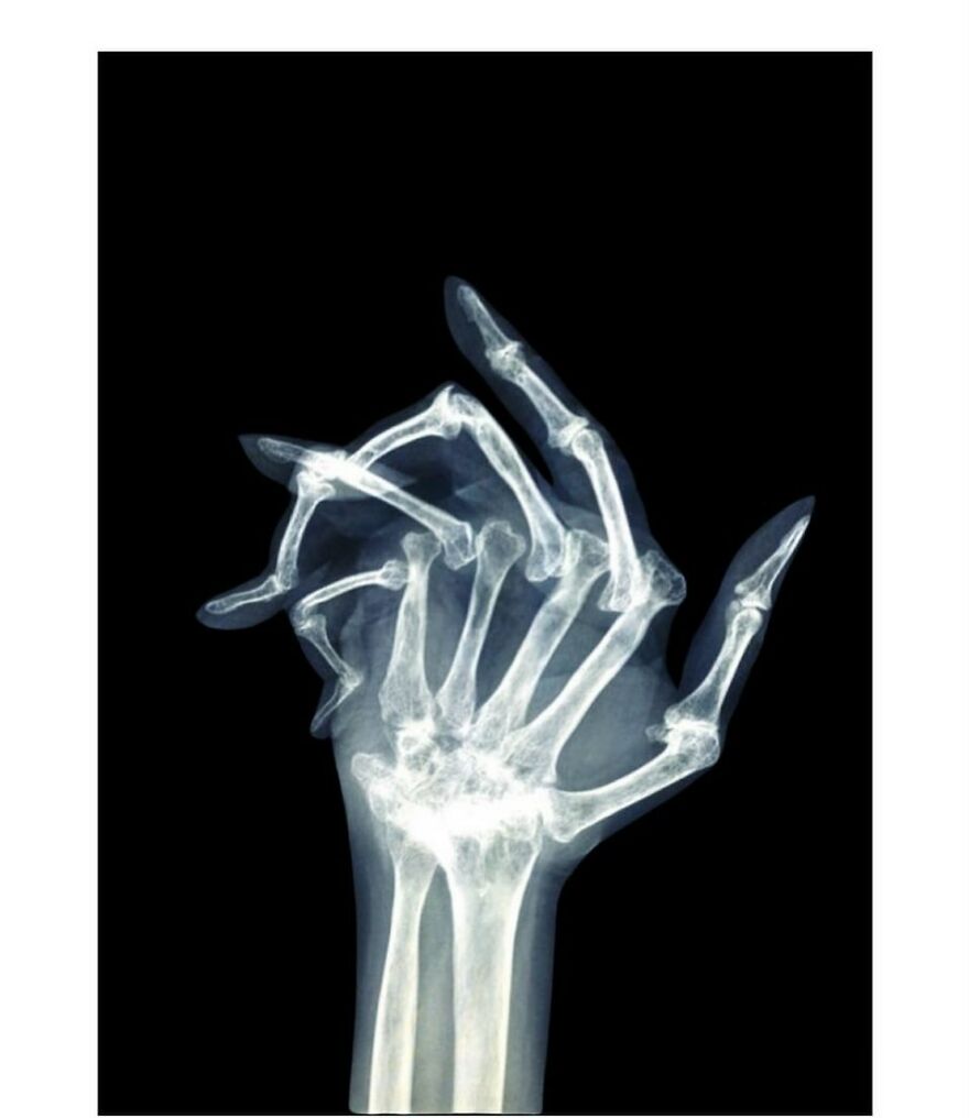 X-ray showing multiple overlapping hand bones in an eerie bizarre medical image from an Instagram account.