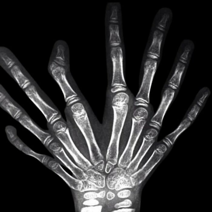 Radiografía médica de una mano con deformaciones óseas que muestran lo aterrador del cuerpo humano en detalle.