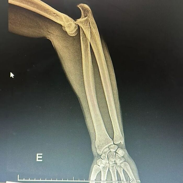 X-ray image of a fractured forearm showing bones and wrist in a medical diagnostic setting with focus on body keeps the score.