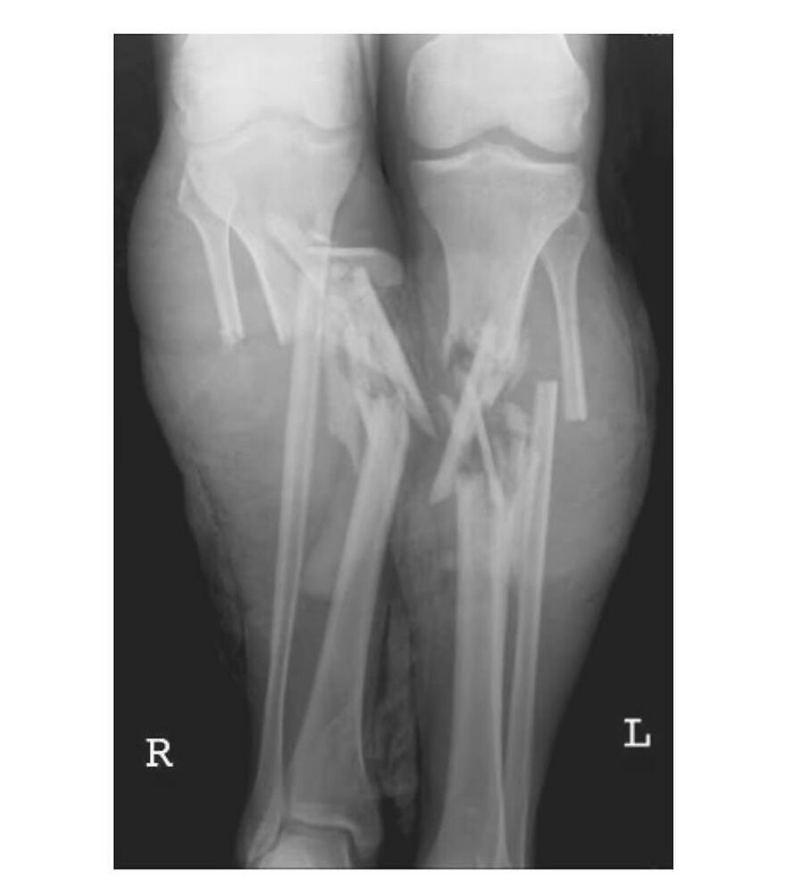 X-ray image showing bizarre fractured bones with metal implants, highlighting eerie and unusual medical conditions.