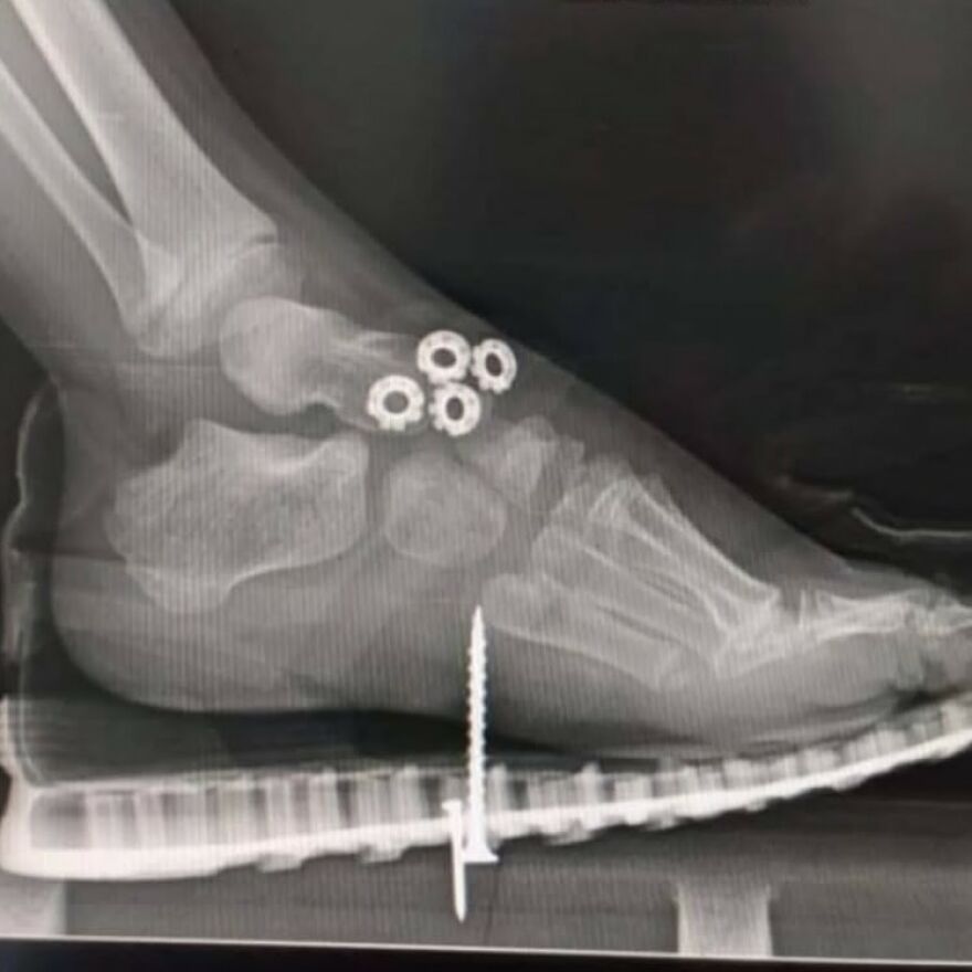 X-ray of foot showing bizarre medical hardware including washers and a large s***w in the bones, highlighting eerie medical pics.
