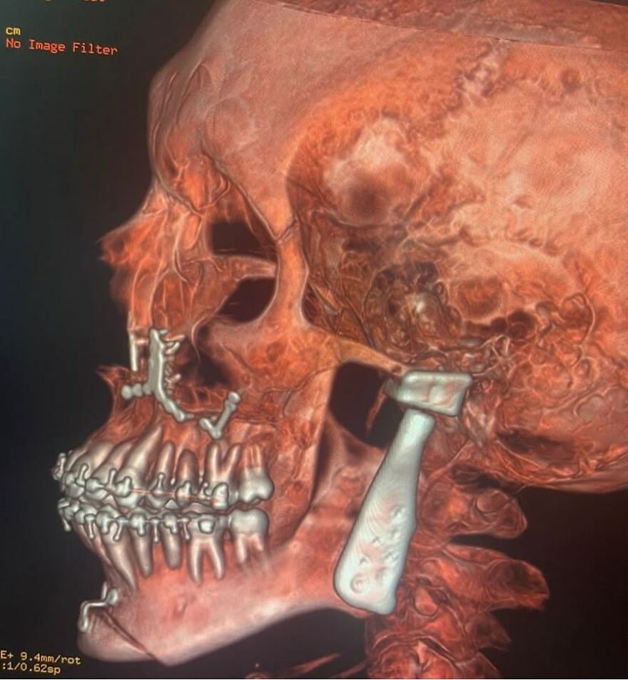 3D medical scan of a human skull with bizarre metal implants and unusual jawbone fixation in eerie detail