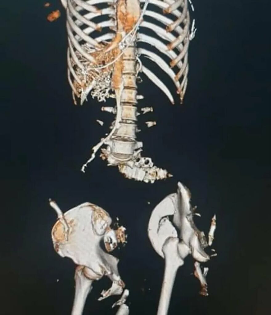 3D medical scan showing a damaged spine and pelvis with fractures, illustrating bizarre medical imagery from an IG account.