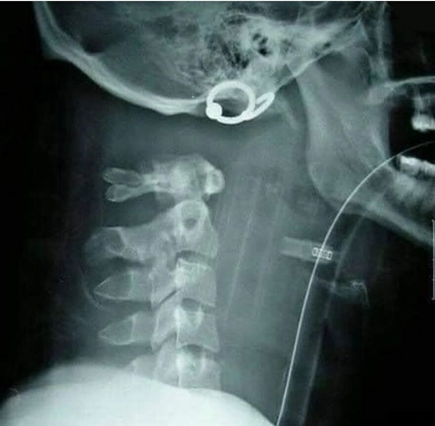X-ray image showing bizarre medical condition with rings and foreign objects in the neck area, illustrating eerie medical pics.