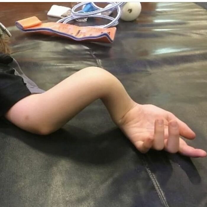 Brazo doblado de forma extraña sobre una superficie oscura, ilustrando fotos médicas del cuerpo aterrador.