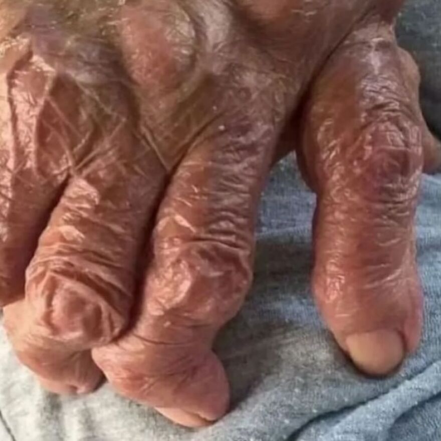 Close-up of a hand showing severe deformities and skin changes featured in bizarre medical pics from an IG account.