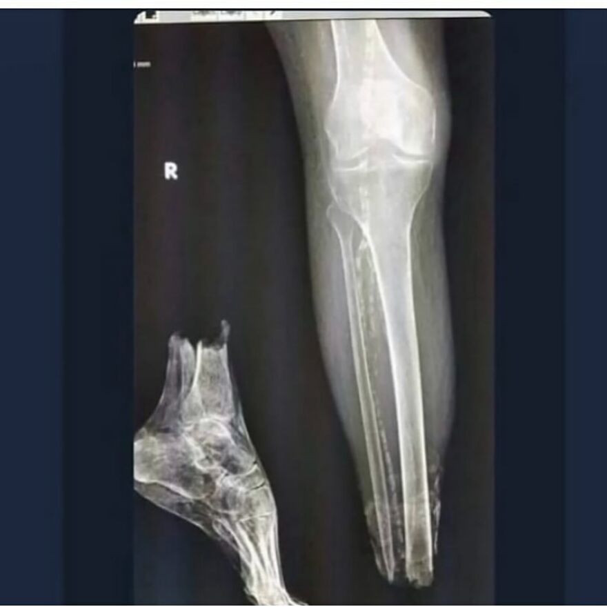 X-ray image showing bizarre medical condition with a severely deformed and fractured lower leg and foot bones.