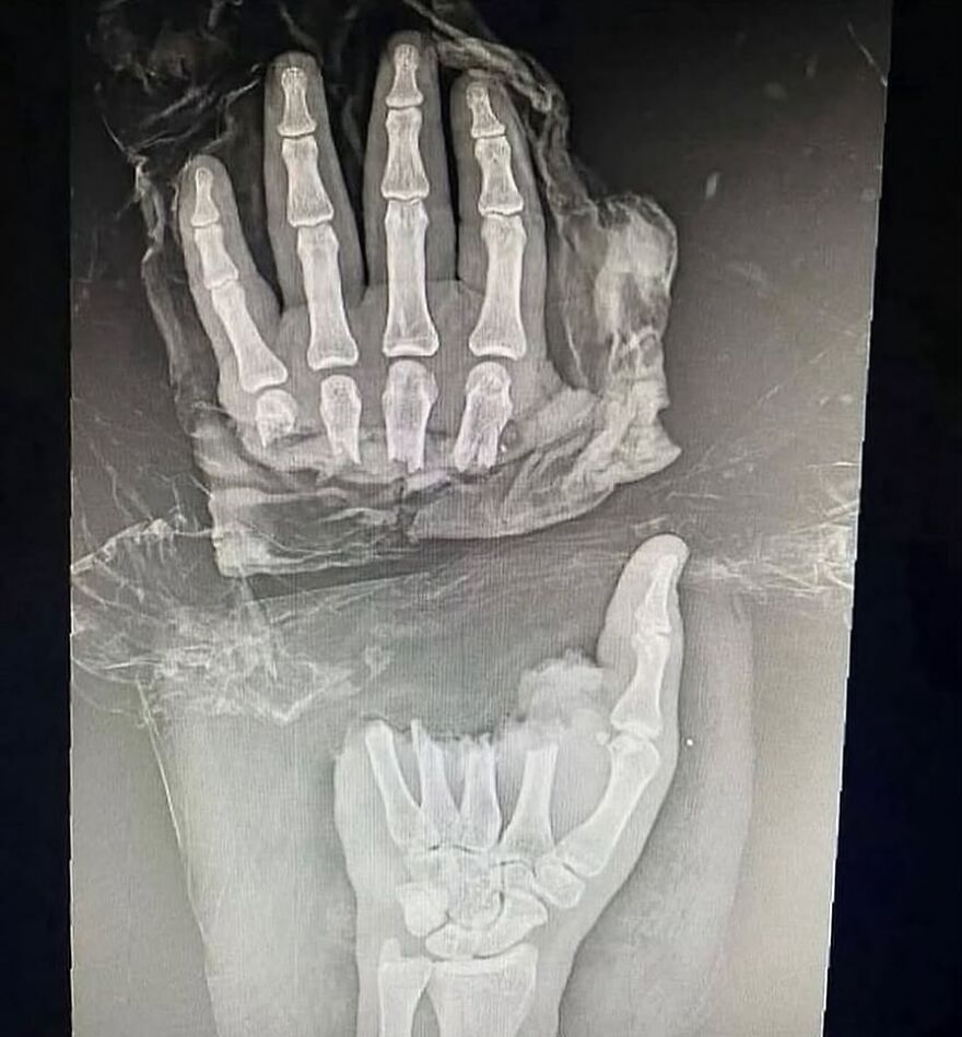 X-ray image showing bizarre and eerie medical condition affecting hand bones with unusual skeletal formation.