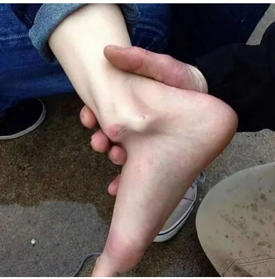 Close-up of a bizarre medical condition showing an unusually shaped human foot held by a person outdoors.