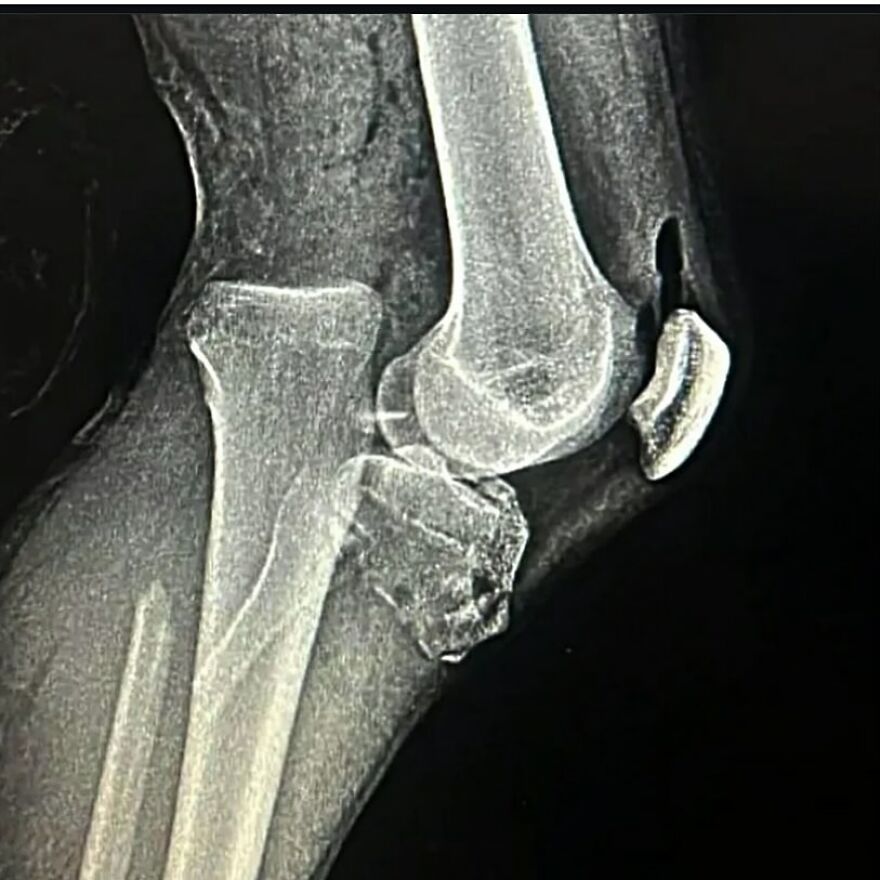 X-ray image showing a bizarre medical condition with fractured bones and unusual bone fragments in the arm.