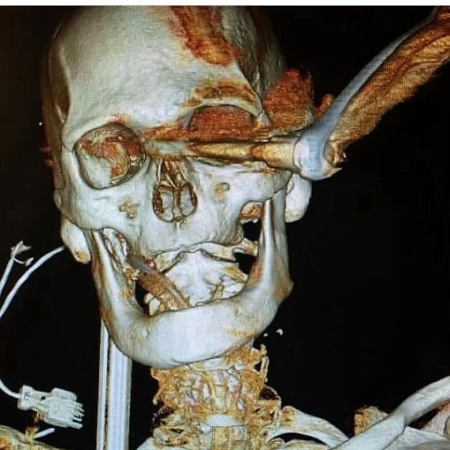 3D medical scan showing a skull with bizarre, eerie objects embedded, illustrating strange medical conditions.
