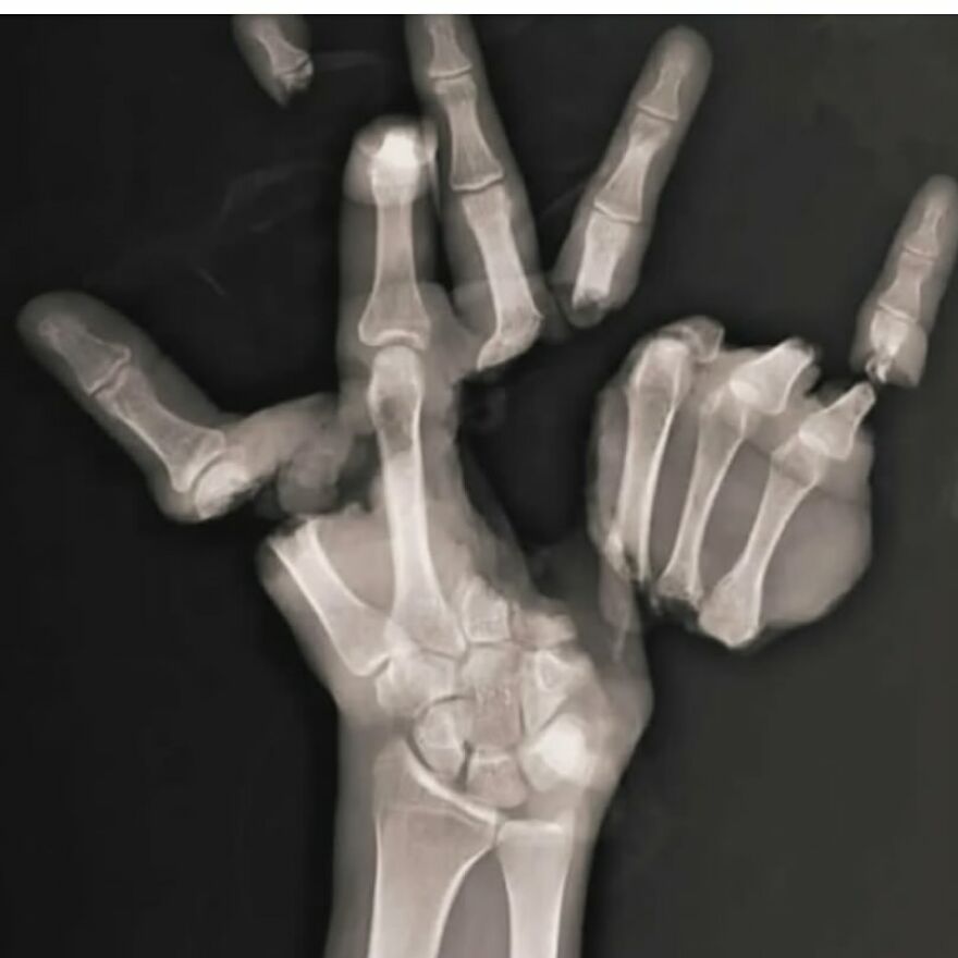 X-ray image showing bizarre medical abnormalities in a human hand with distorted and extra bones.